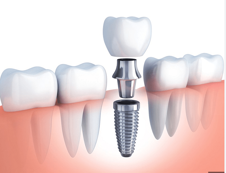 Trồng răng Implant 