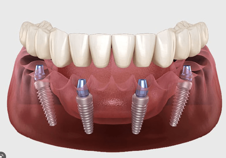 Trồng răng toàn hàm All - On - X 